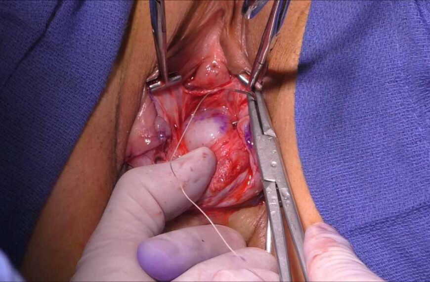 Cosmetic Surgery on Labia