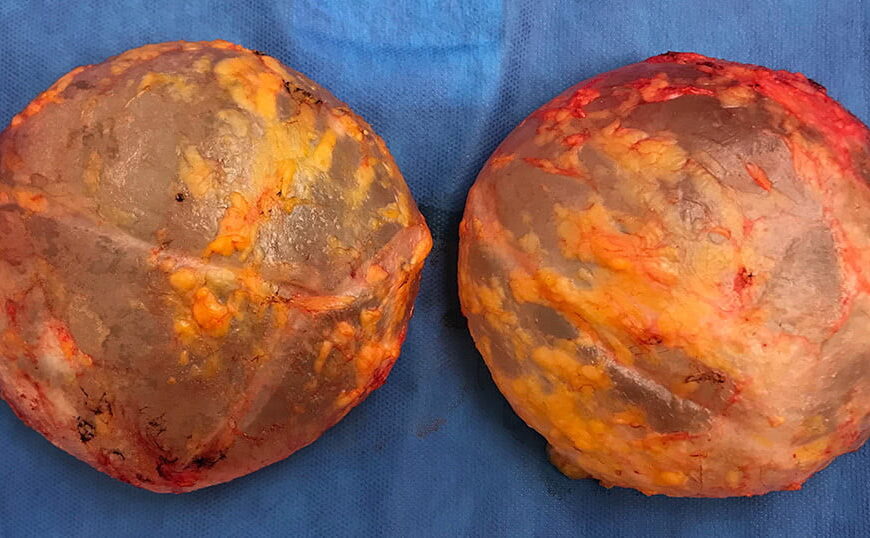 Breast Implant Removal