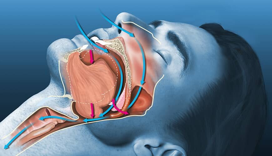 sleep apnoea