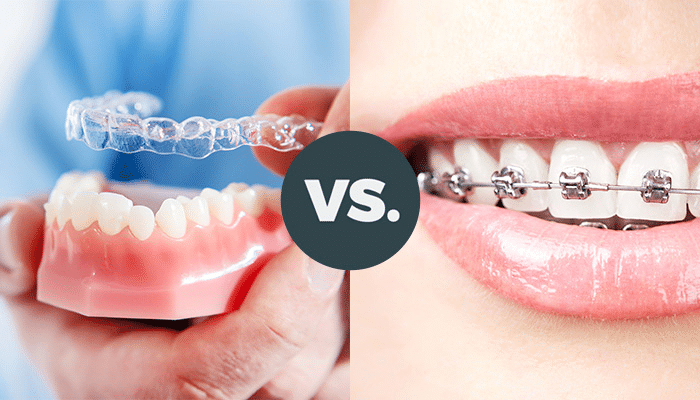 aligners braces