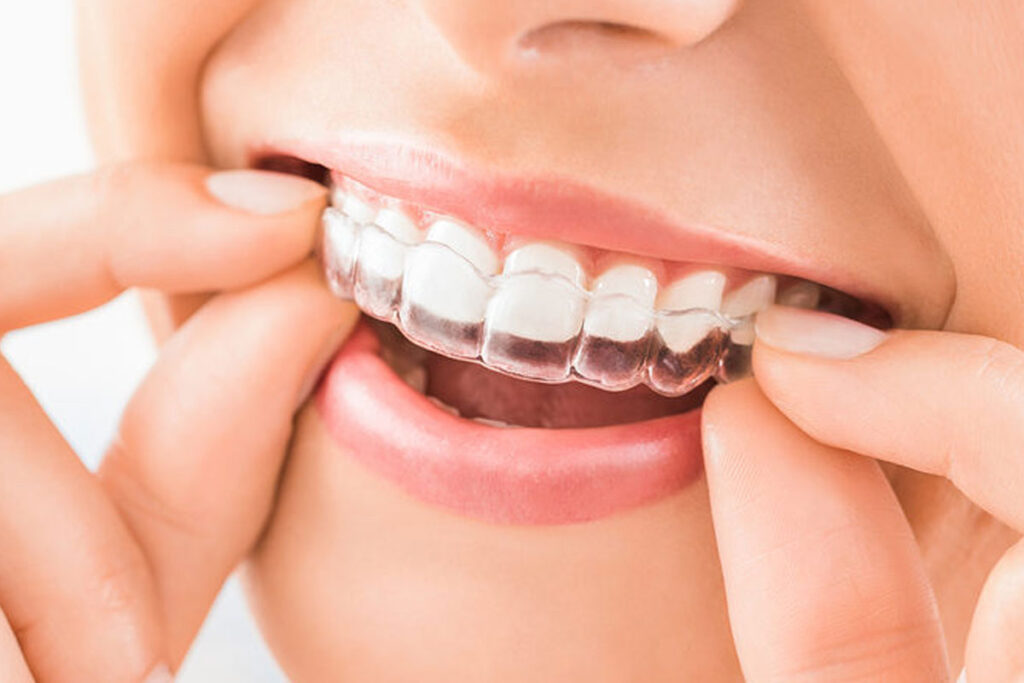 align braces clinic