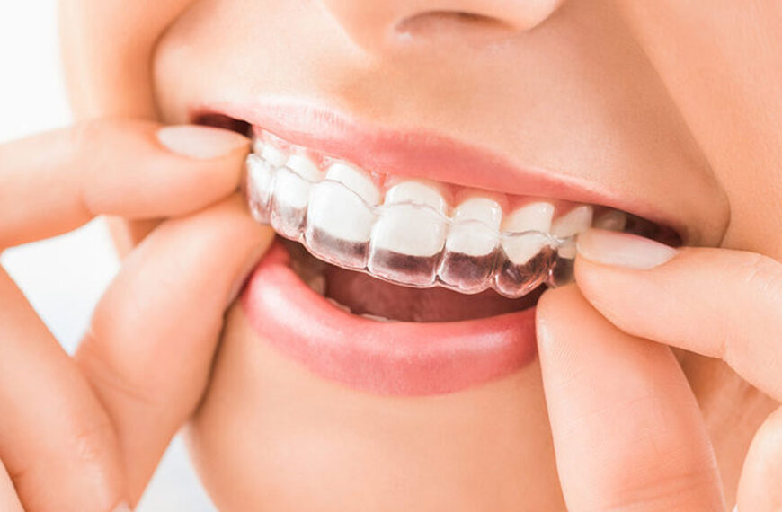 align braces clinic